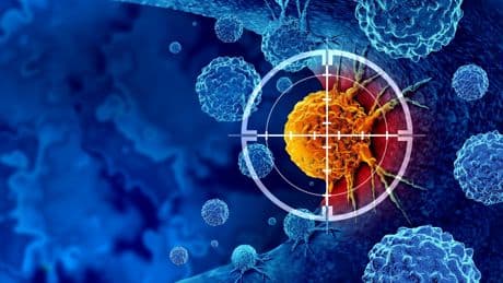 Cancers ORL : l’immunothérapie fait enfin ses preuves pour limiter le risque de rechute