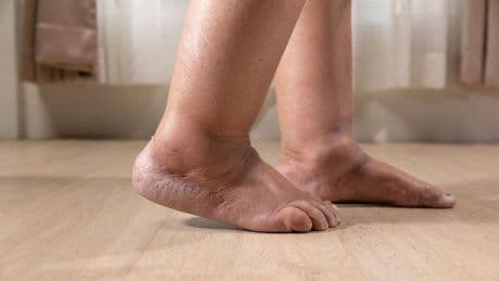 Charcot-Fuß: Welche Symptome auf das versteckte Risiko hinweisen
