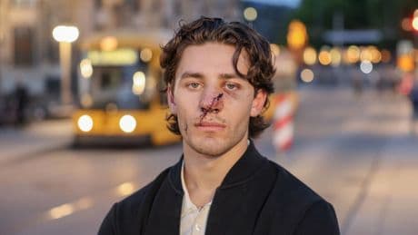 Held von Dresden zurück am Tatort - Angreifer schlitzte Gesicht mit Teppichmesser auf