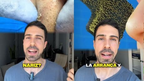 Álex Docampo, dermatólogo: “Esos puntos negros que ves en la nariz no son acné ni suciedad, y si los arrancas con tiras solo dañas tu piel”
