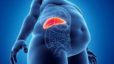 El 80% de jóvenes con sobrepeso padecen hígado graso, enfermedad que puede producir cirrosis o cáncer