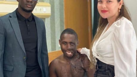 Yüzü yanan Ugandalı çobana Ankara'da tedavi