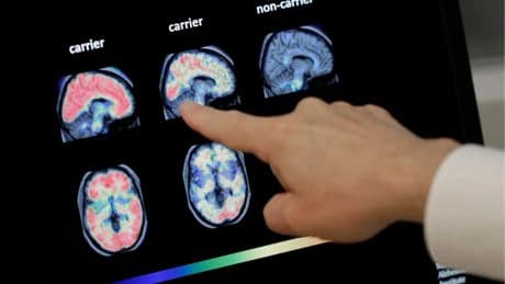 Neuer Bluttest: Kann man damit Alzheimer früher erkennen?