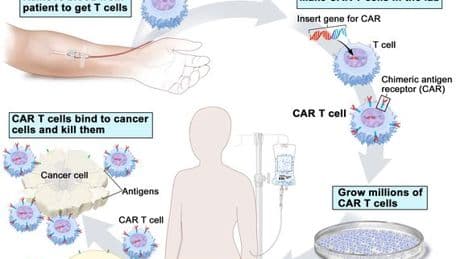 L’immunoterapia anti tumorale Car-T: una promessa per i pazienti, una sfida per il servizio sanitario