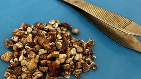 Hastanın iki böbreğinden 300'ün üzerinde taş çıktı