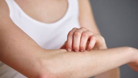 Plötzlich rote Flecken an den Beinen? Alles über Erythema Nodosum