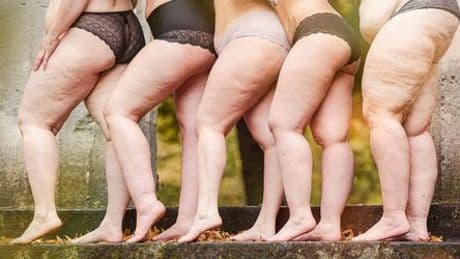 Lipödem: Fettabsaugung wird Kassenleistung - was Patientinnen wissen müssen