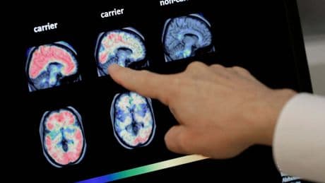 Weight-loss drugs among breakthrough trials offering ‘hope’ for dementia prevention