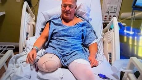 WWE star, 55, gets leg amputated after over 30 surgeries to save limb
