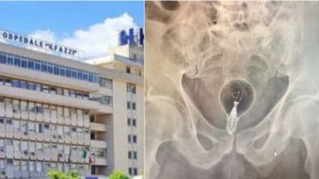 Lecce, 85enne ricoverato d'urgenza in ospedale: aveva una lampadina nel retto