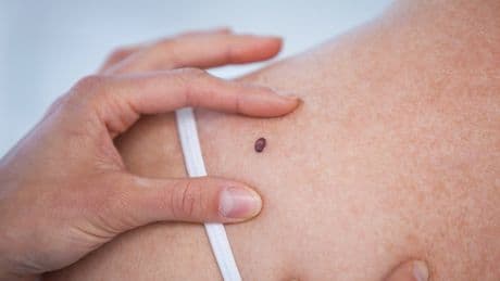 Warning signs of melanoma and how to tell if a spot is cancerous