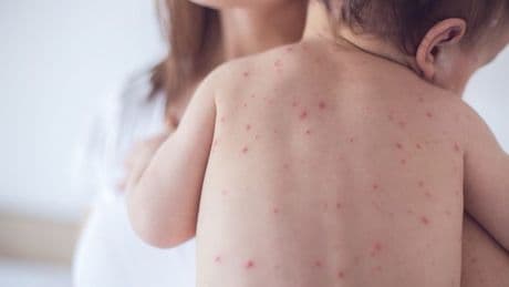 Measles warning to holidaymakers as outbreaks surge in major tourist hotspots