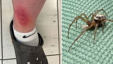 Man 'struggling to walk' after horror bite from 'Britain’s most dangerous spider' false widow