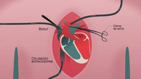 Las cuatro fases de una operación de trasplante de corazón
