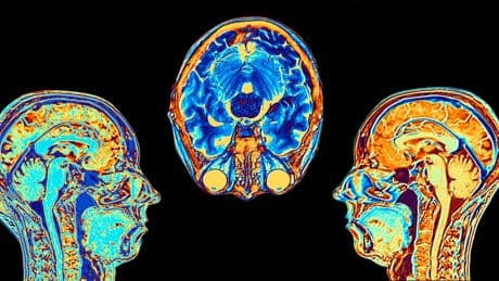 Parkinson: Warum immer mehr Menschen erkranken – und was dagegen hilft