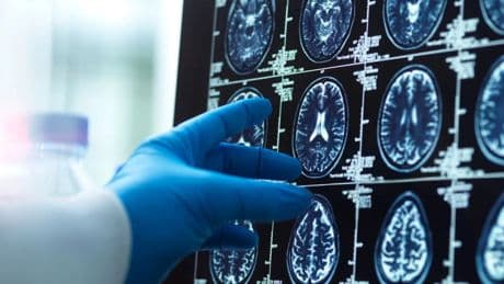 Investigadores españoles lideran el primer atlas cerebral transdiagnóstico de los trastornos mentales