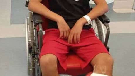 Papà in campo, botte al calciatore: rotti zigomo e malleolo