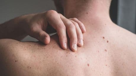 Krebstherapie: Kampf gegen den Hautkrebs: "Vor zehn Jahren hatten wir kaum Optionen"