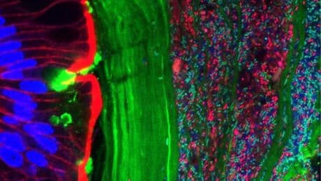 Una terapia pionera trata las piedras en el riñón con bacterias que modifican el microbioma intestinal