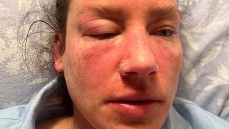 'My skin is constantly on fire and I look like I've been burned because of a common cream'