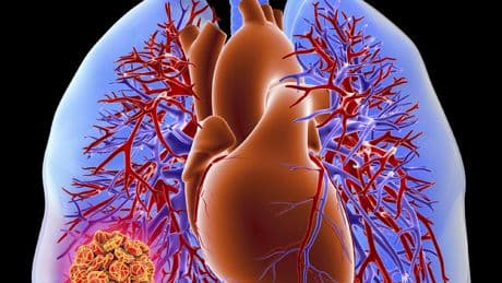 Symptome, Ursache, Behandlung - Lungenfibrose: Alles, was Sie wissen müssen