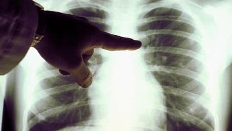 El dolor de pecho que puede esconder un cáncer de pulmón: los síntomas del tumor más mortal