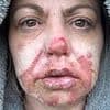 Mother, 52, is left with agonising second-degree burns after tealight exploded in her face