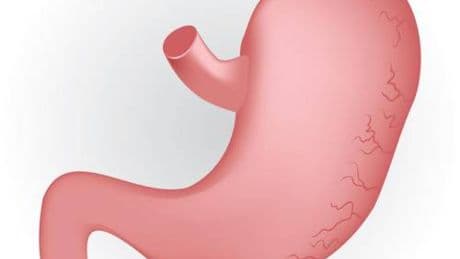 Caldo peggiora sintomi del reflusso, in casi gravi "chirurgia opzione risolutiva"