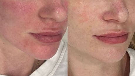 ‘I destroyed my skin barrier but this peptide-fuelled night cream healed it in days’