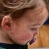 Measles holiday warning as cases rise in Europe