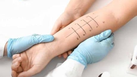 Quali test fare per valutare se si è allergici?
