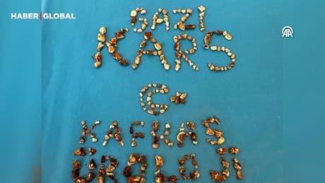 Doktorlar şoke oldu, hastanın böbreklerinden 300'ün üzerinde taş çıktı