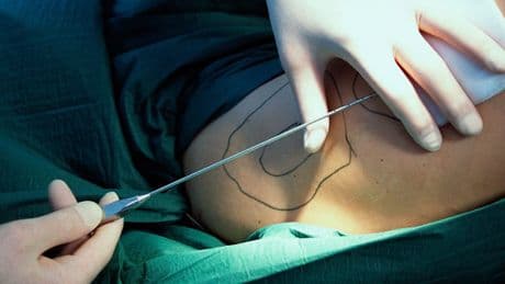 Endlich! - Fettabsaugung bei Lipödem zahlt jetzt die Krankenkasse