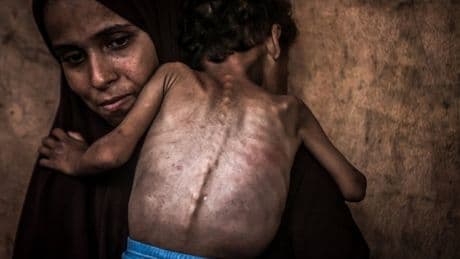 What happens to the body when it’s dying of starvation amid Gaza hunger crisis