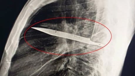Ağrı şikayetiyle gitti, göğsünden bıçak çıktı: 8 yıl birlikte yaşamış