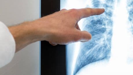 Schulbegleitung erkrankt: Tuberkulose-Fall am Hardtberg-Gymnasium in Bonn