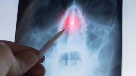 Rinosinusite cronica con poliposi nasale, l'otorino: "Con biologici verso remissione"