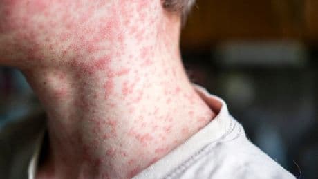 UK issues measles warning to holidaymakers as cases surge in Europe