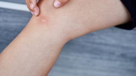 Bye-bye, Mückenspray: Diese Lotions schützen sanft – und duften besser
