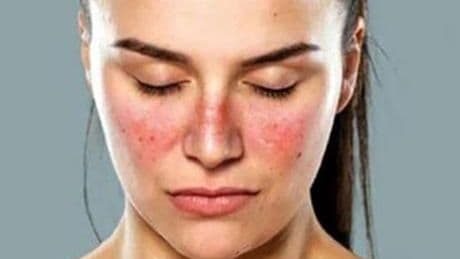 Yüzünüzdeki lekeler lupus belirtisi olabilir! Pek çok organı etkileyebiliyor