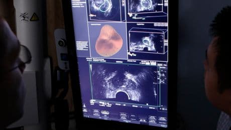 Reduced Screening May Have Led to Rise in Advanced Prostate Cancer Diagnoses