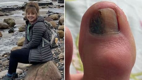 'My doctor told me the mark on my toenail was an infection - but it was cancer'