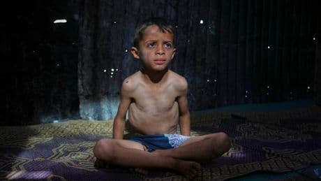 AP PHOTOS: Many in Gaza face malnutrition and hunger as blockade enters its third month