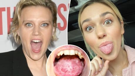 What is ‘geographic tongue’? All about ‘SNL’ star Kate McKinnon’s ‘gross’ condition