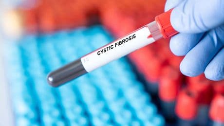 ‘Life-changing’ therapy now available for cystic fibrosis patients