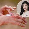 The experts' guide to fighting eczema: From cosmetics to stress and the foods you should avoid, how to prevent flare-ups of the cruel condition