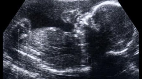 Cytomégalovirus : « Le dépistage systématique chez les femmes enceintes est une urgence sanitaire et éthique »