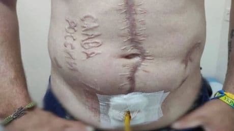 Grausame Folter - Russen brennen Ukrainer Parole in Bauch
