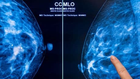 Mammografie-Screening senkt Brustkrebs-Sterblichkeit