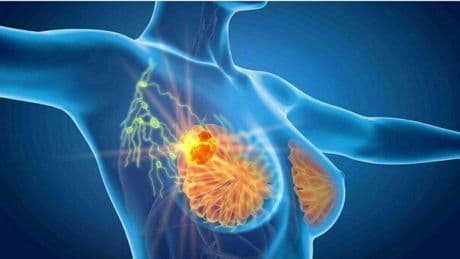 Tumore al seno avanzato, terapia ormonale di nuova generazione riduce il rischio di morte